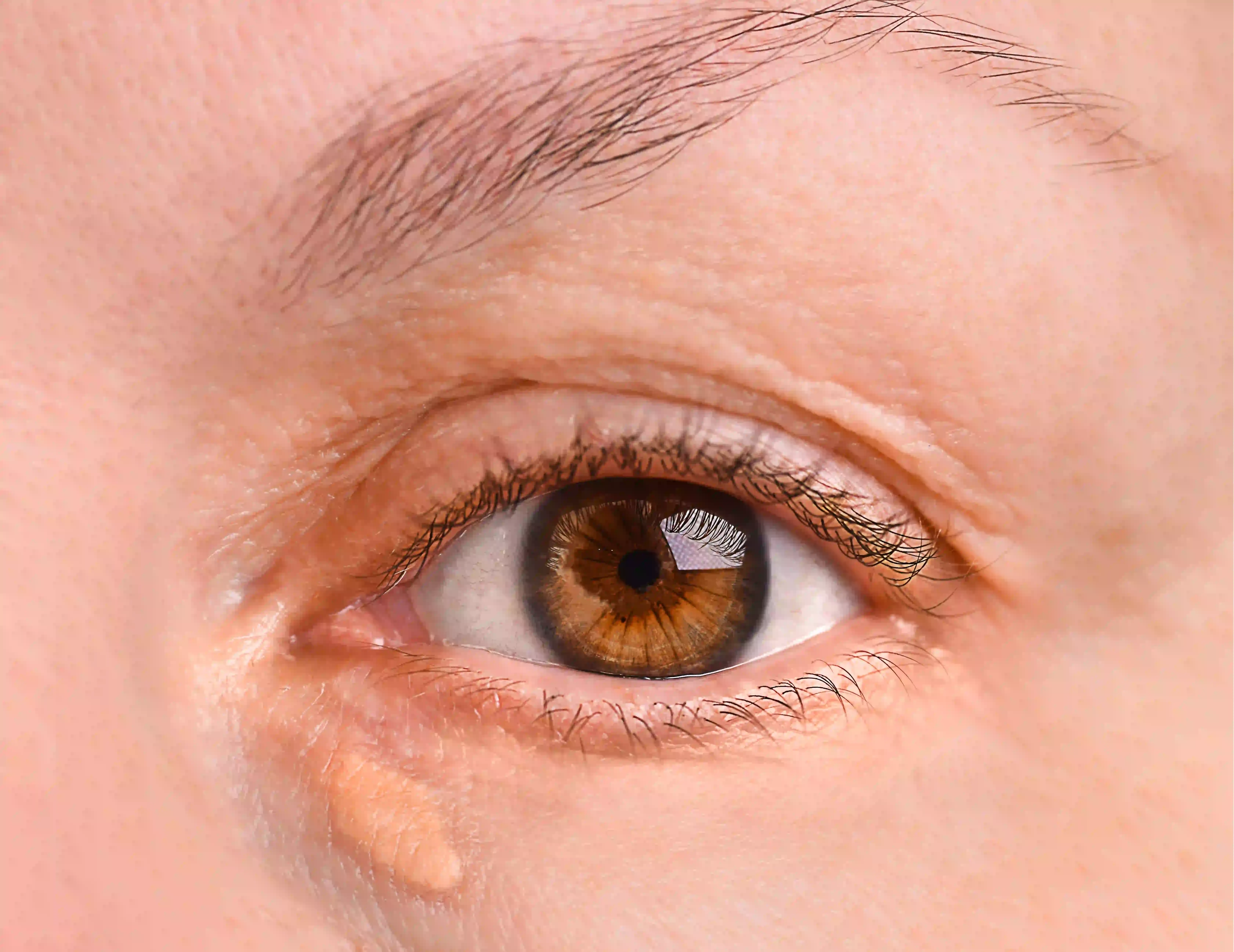 xanthelasma adalah