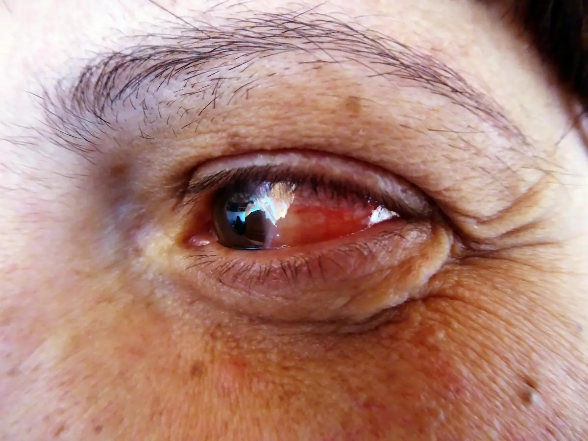 gejala awal kanker mata