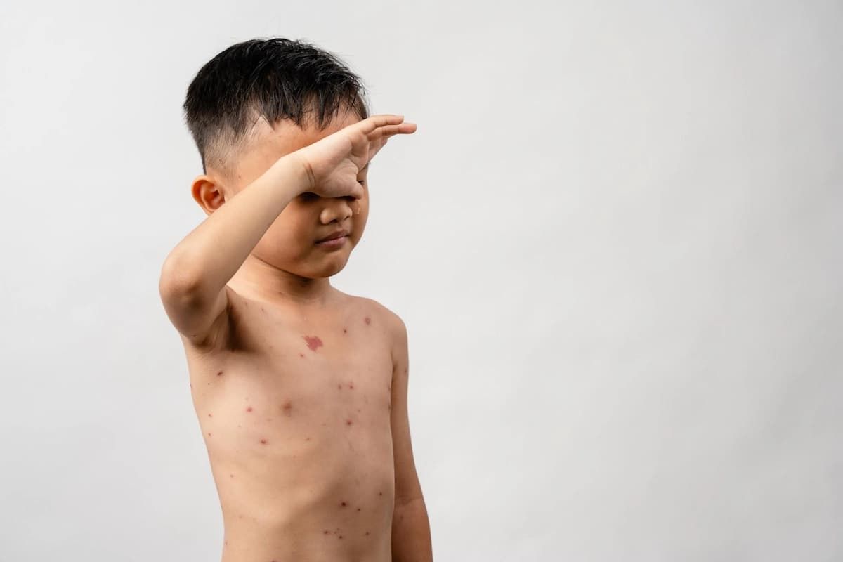 Herpes zoster ophthalmicus