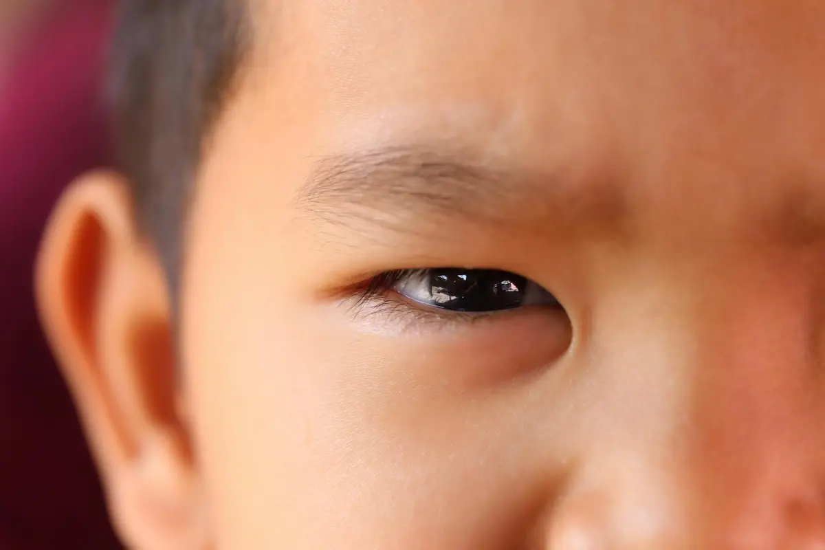 Microphthalmia