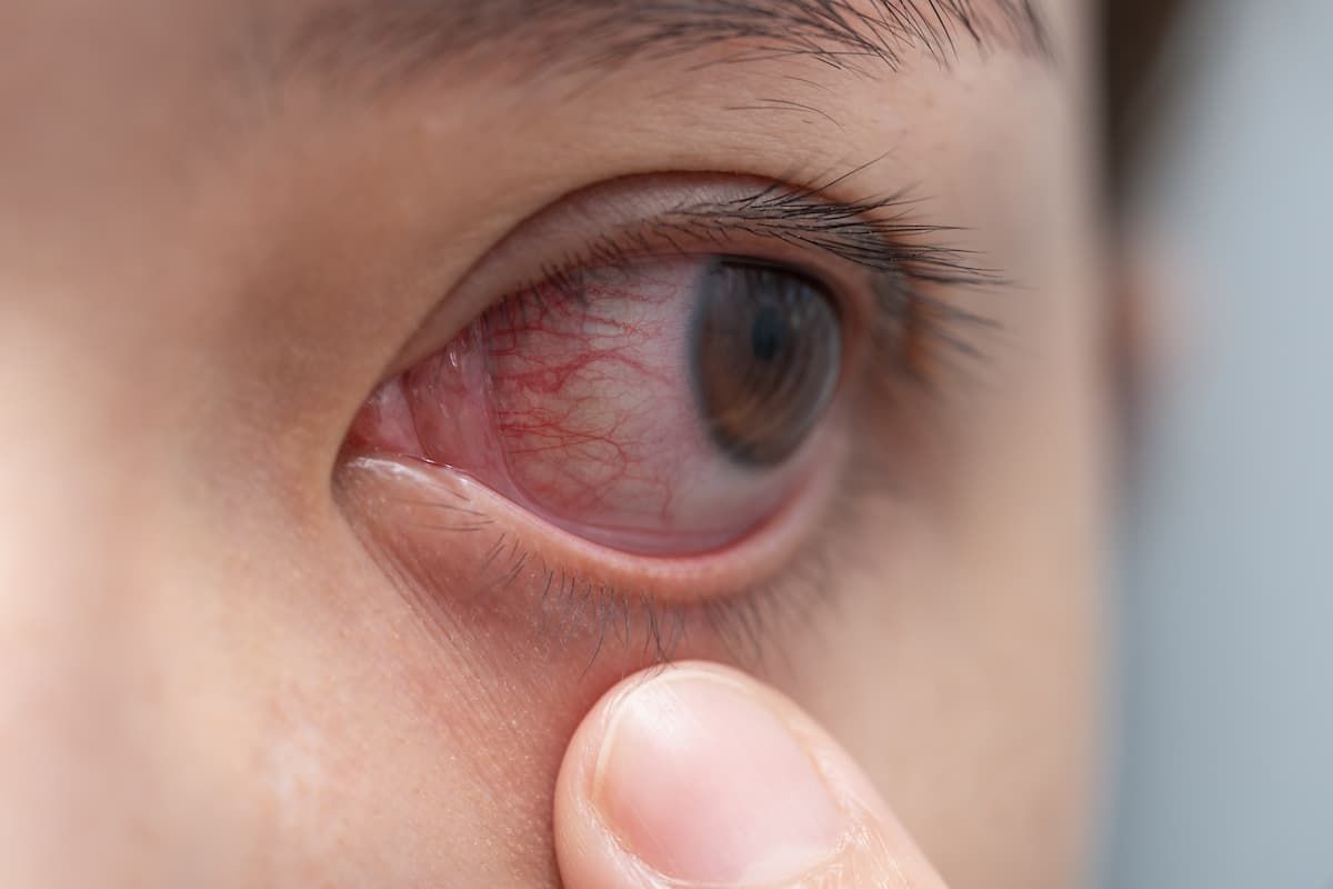 Nistagmus