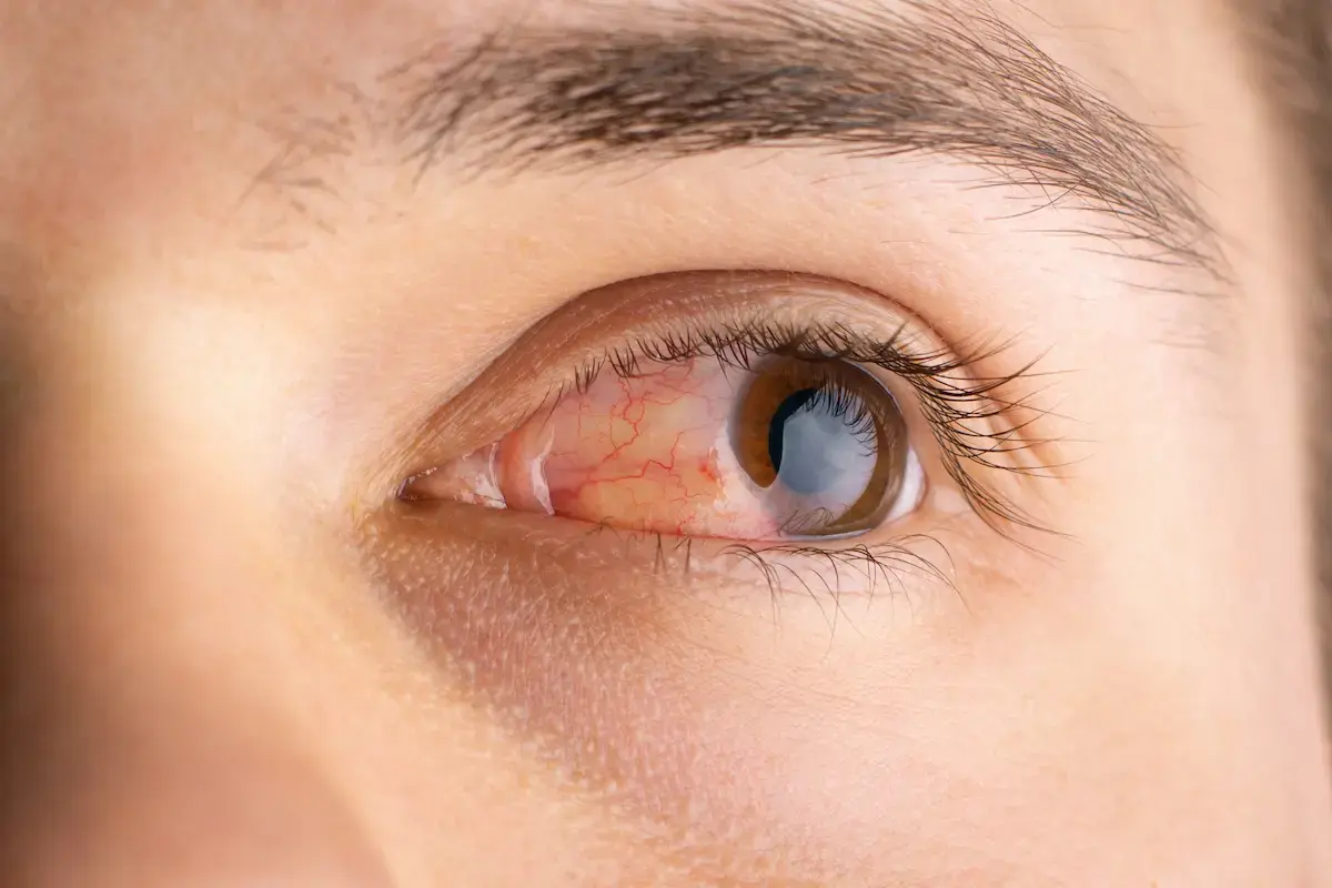 optic nerve damage