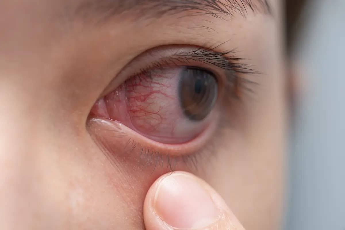 Vitreous hemorrhage