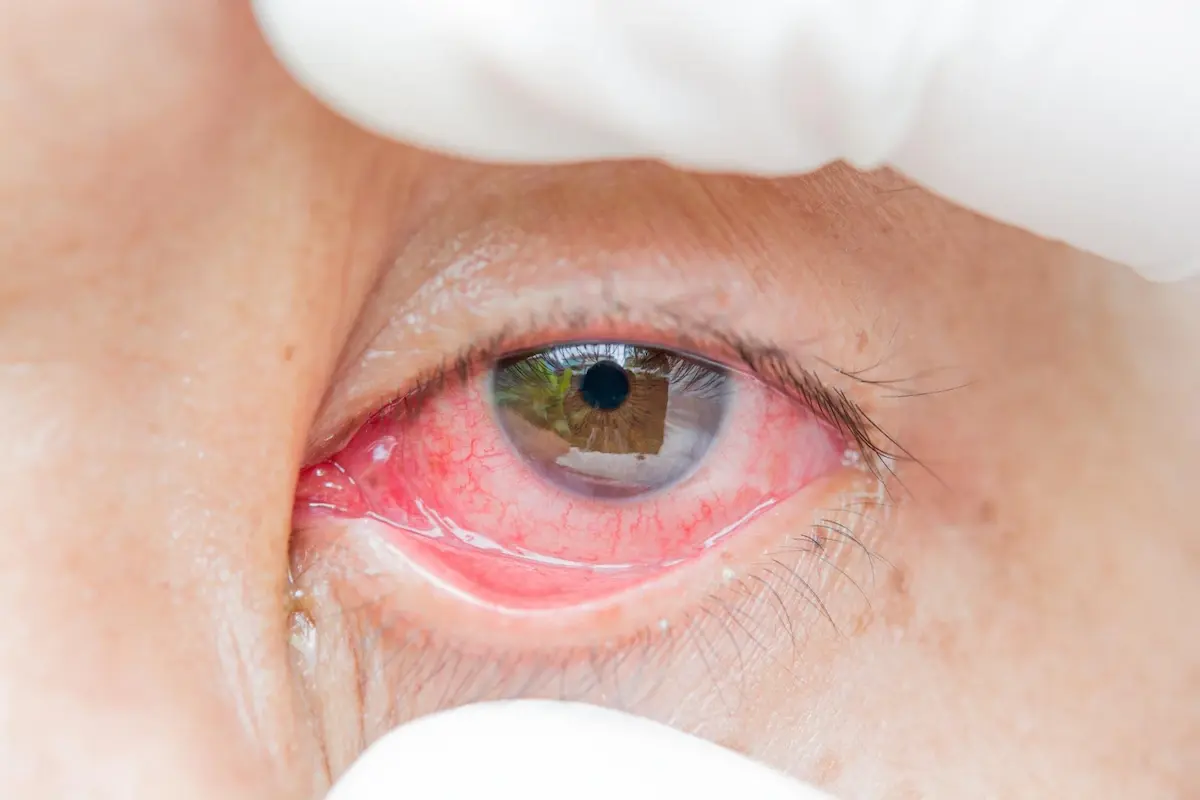 Episkleritis
