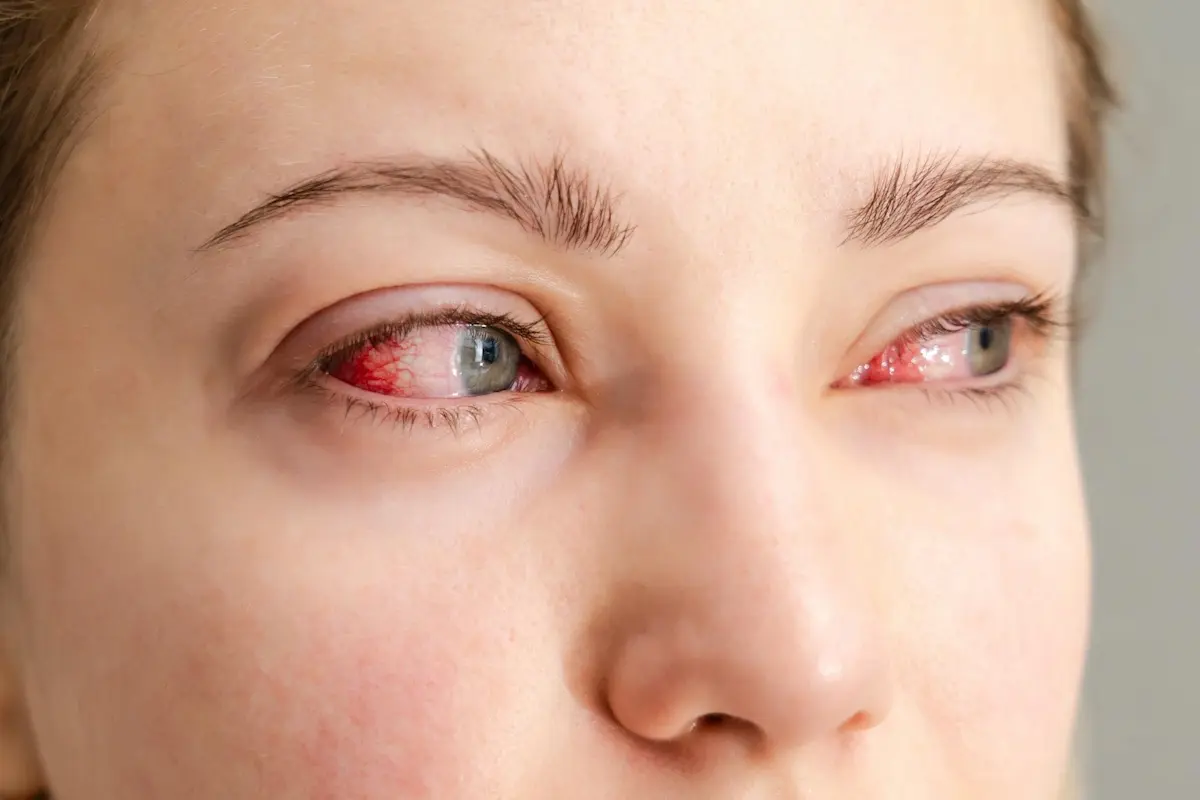 konjungtivitis