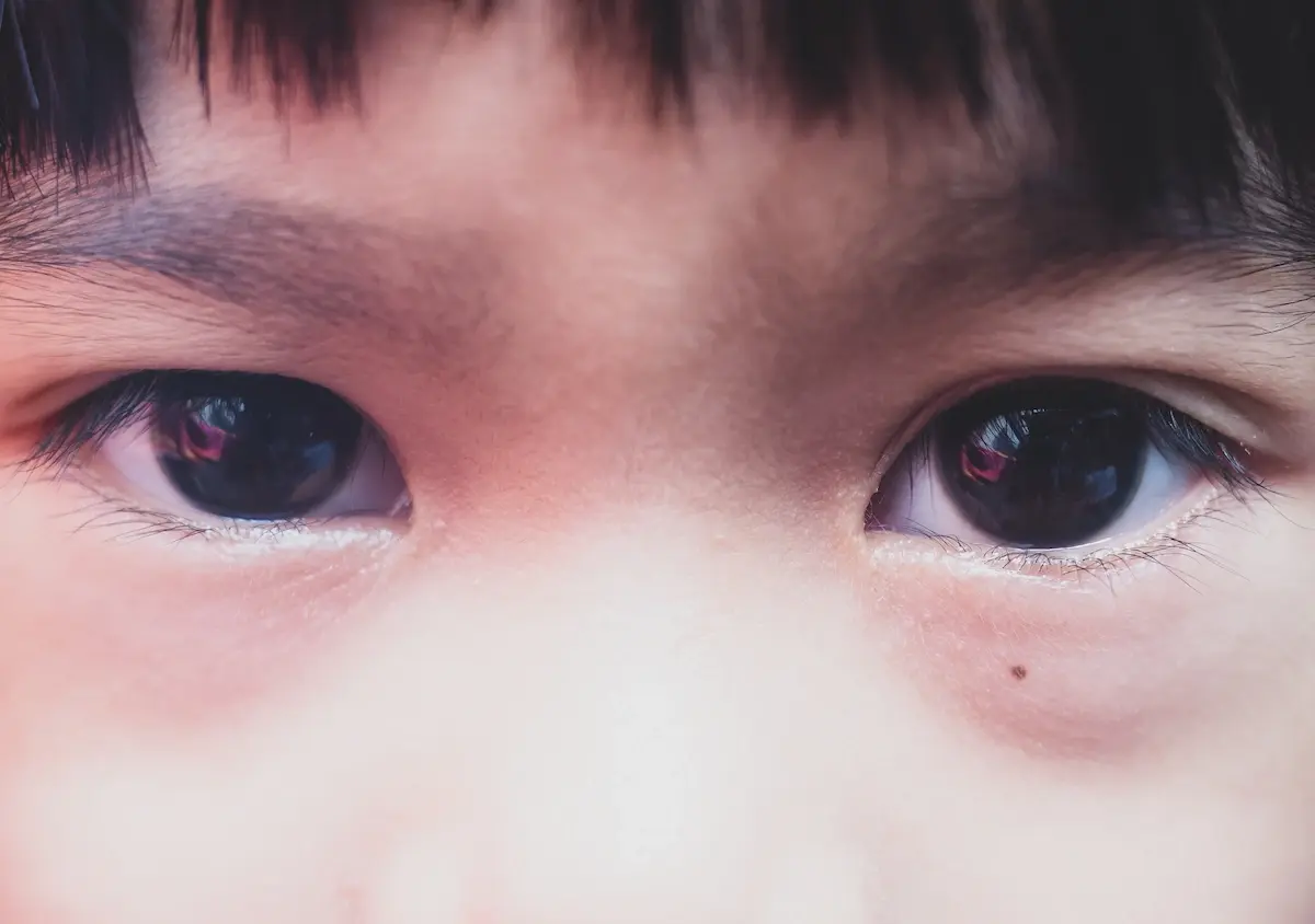 Retinoblastoma