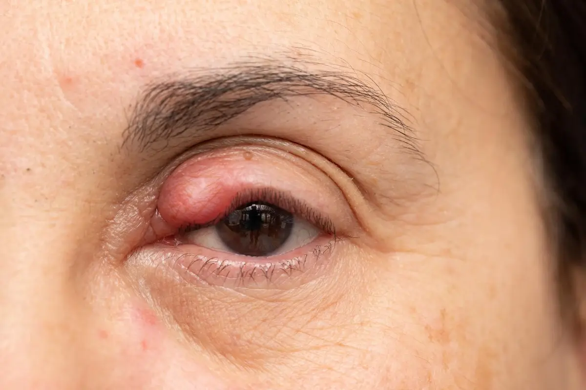 tumor kelopak mata